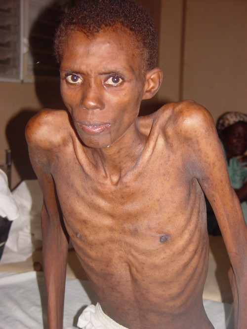 Joseph Jeune before receiving antiretroviral therapy (David Walton)